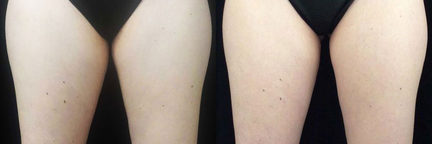 CoolSculpting Before After Photos Thighs